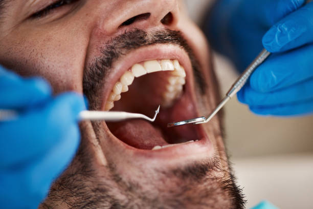 Best Emergency Dental Care for Abscessed Tooth in Beechwood, MI